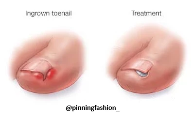 Ingrown Nail Treatment